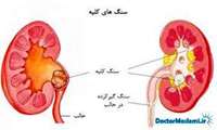 کم تحرکی، زمینه ساز بیماری های کلیوی